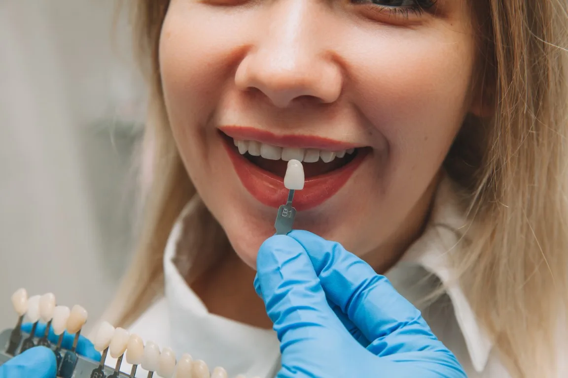 Porcelain veneer being placed on a front tooth at Peninsula Dentistry in Huntington Beach